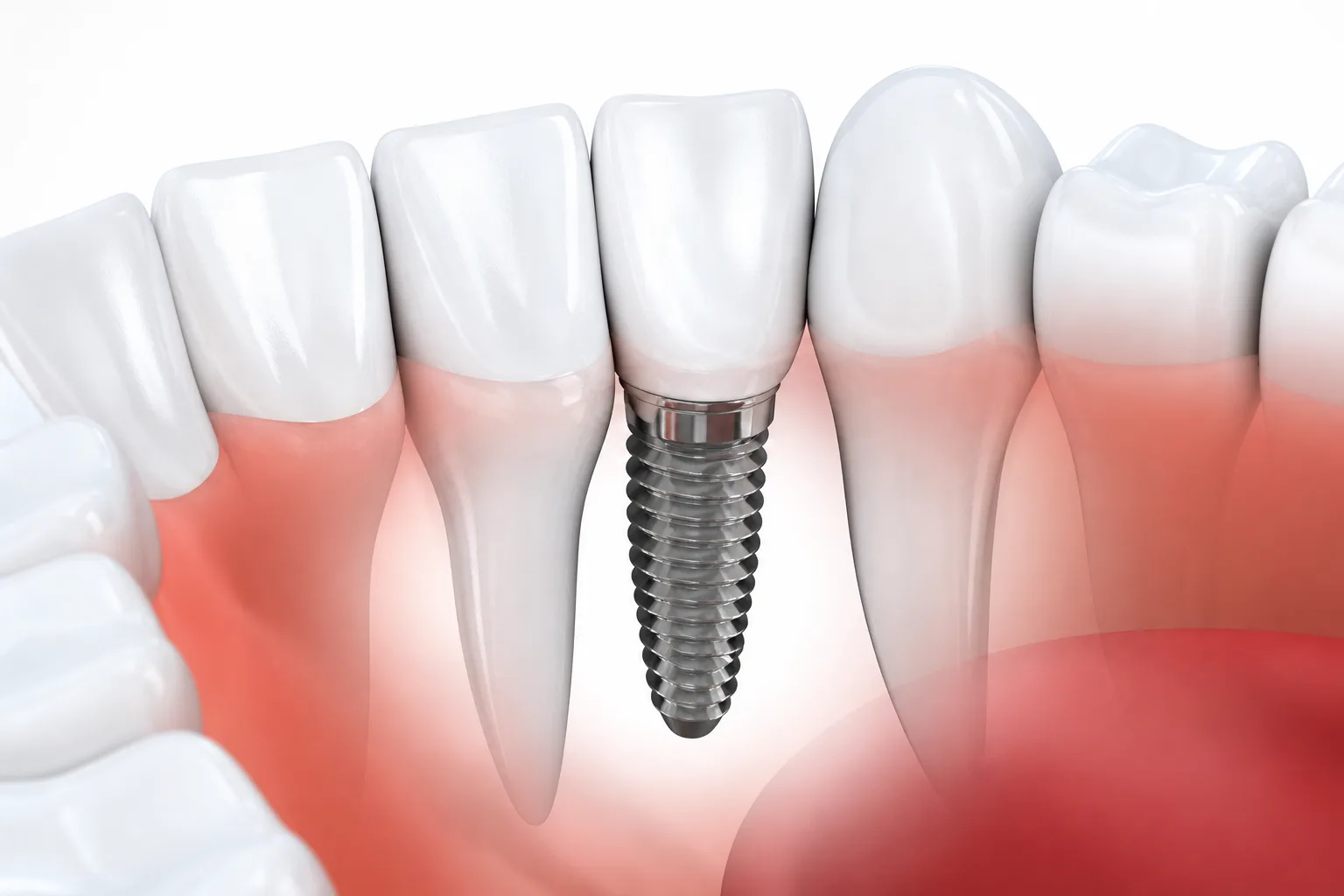 Vite implantare in titanio inserita nell'osso mandibolare